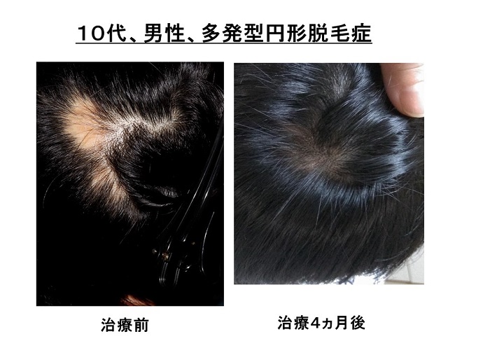 円形脱毛症　病院